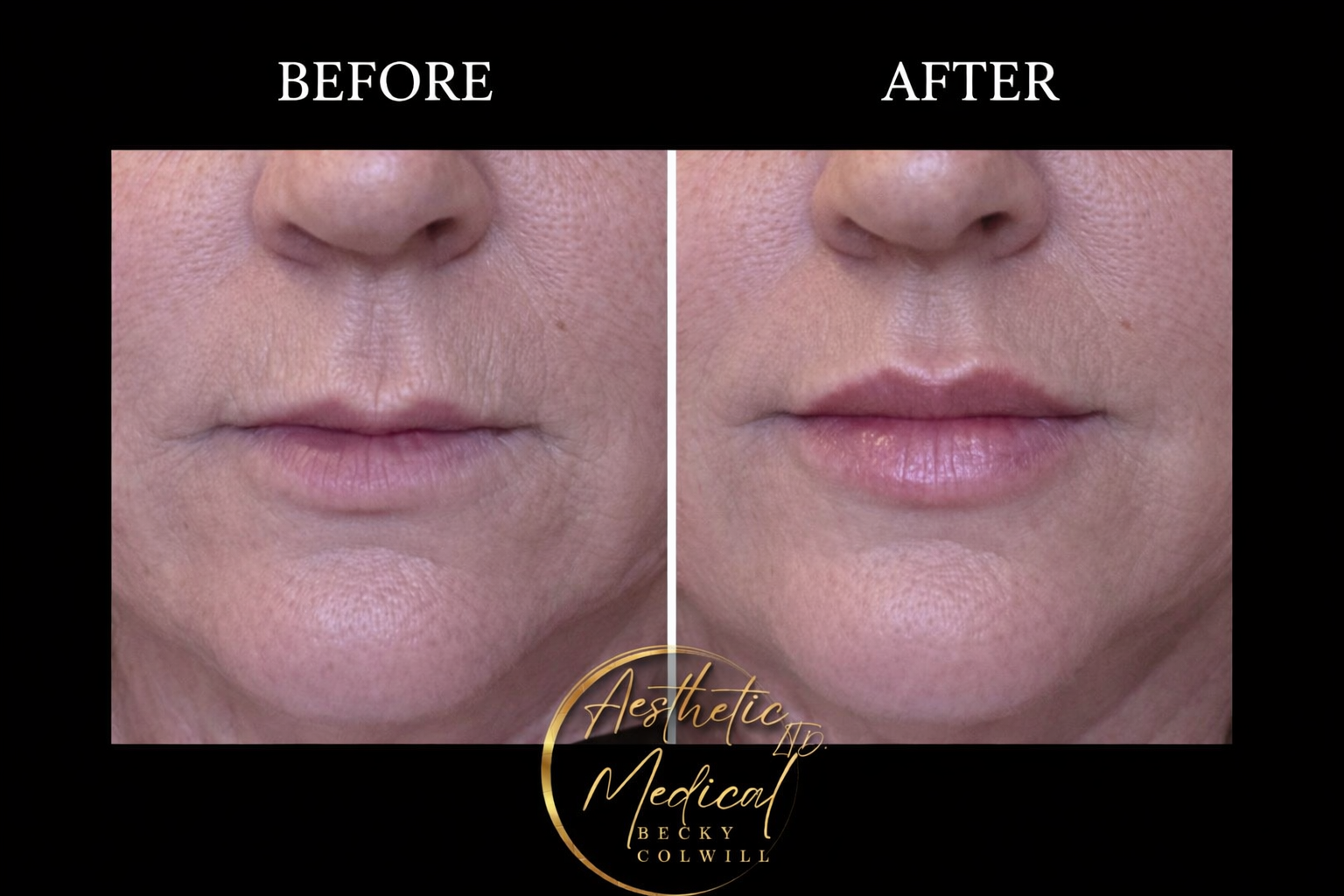 Lip Filler