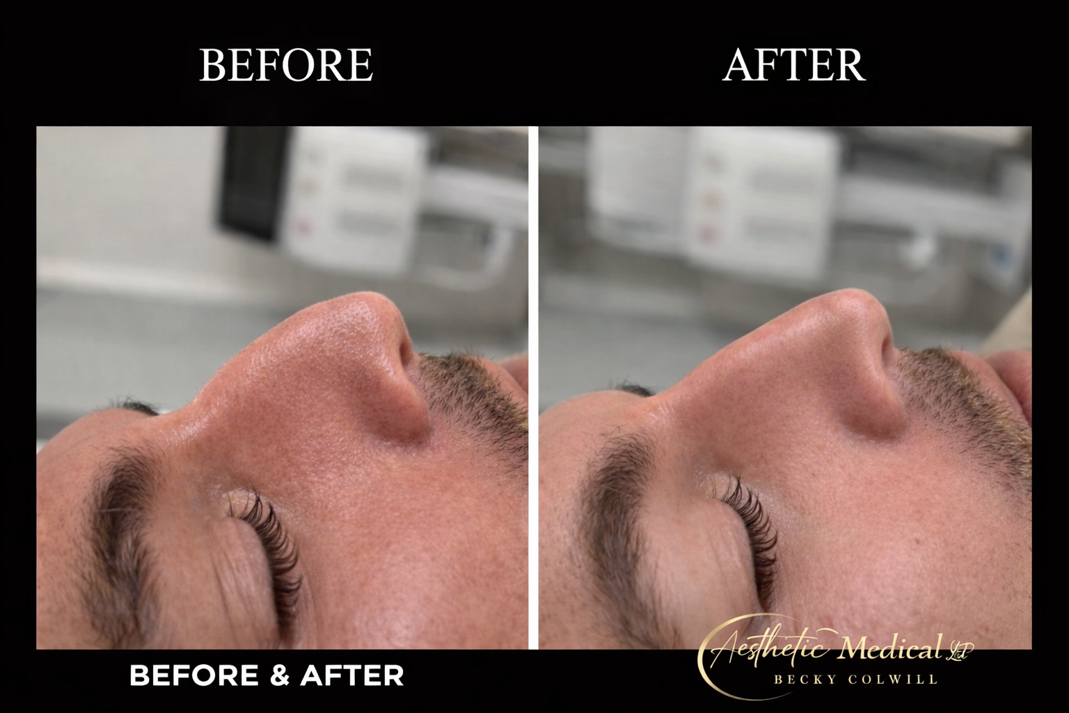 Non-Surgical Rhinoplasty