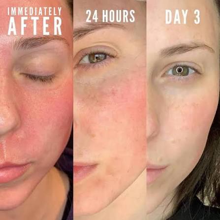 CO2 Fractional Laser results - Immediately after, 24 hours, and Day 3 recovery progression