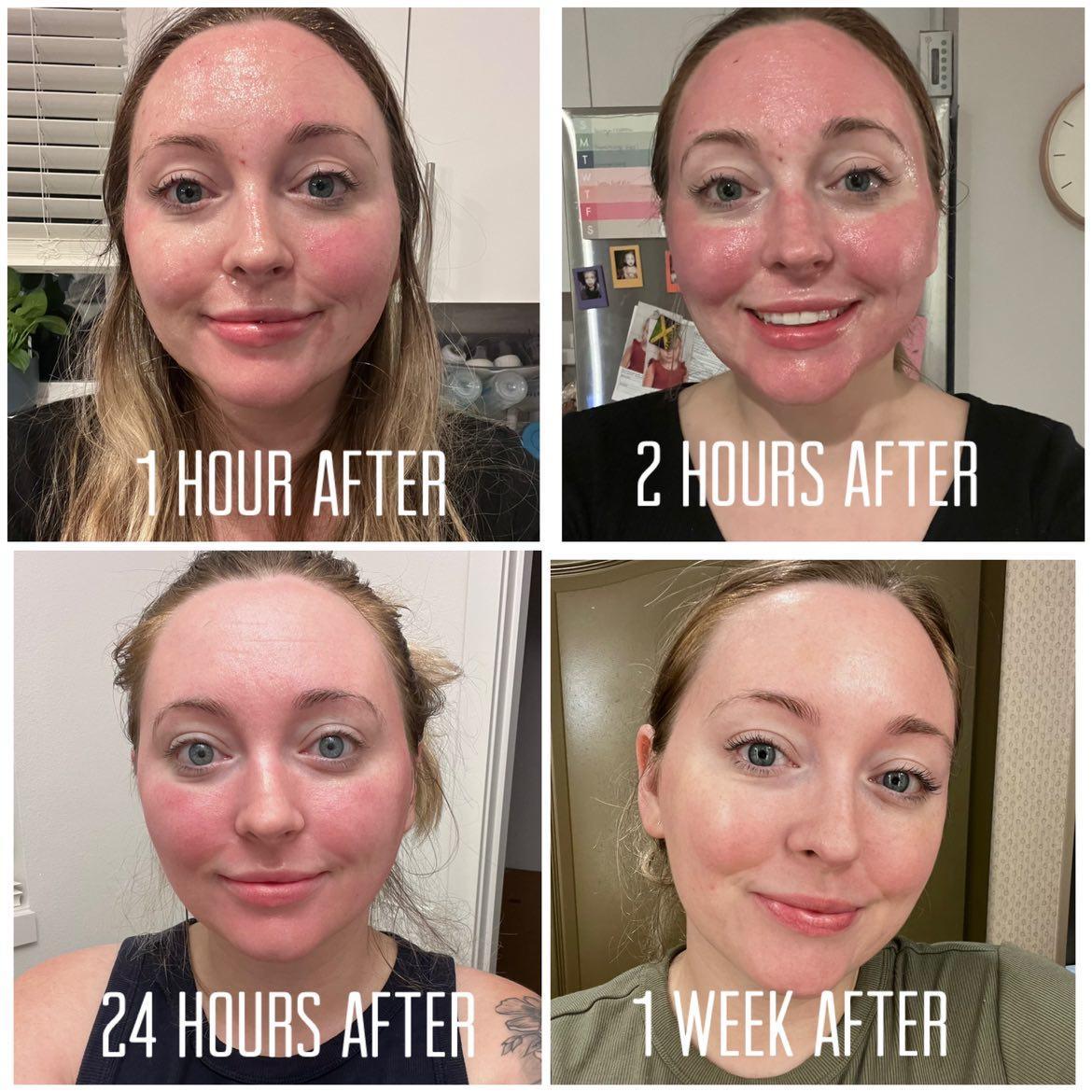 CO2 Fractional Laser recovery timeline - 1 hour, 2 hours, 24 hours, and 1 week after treatment