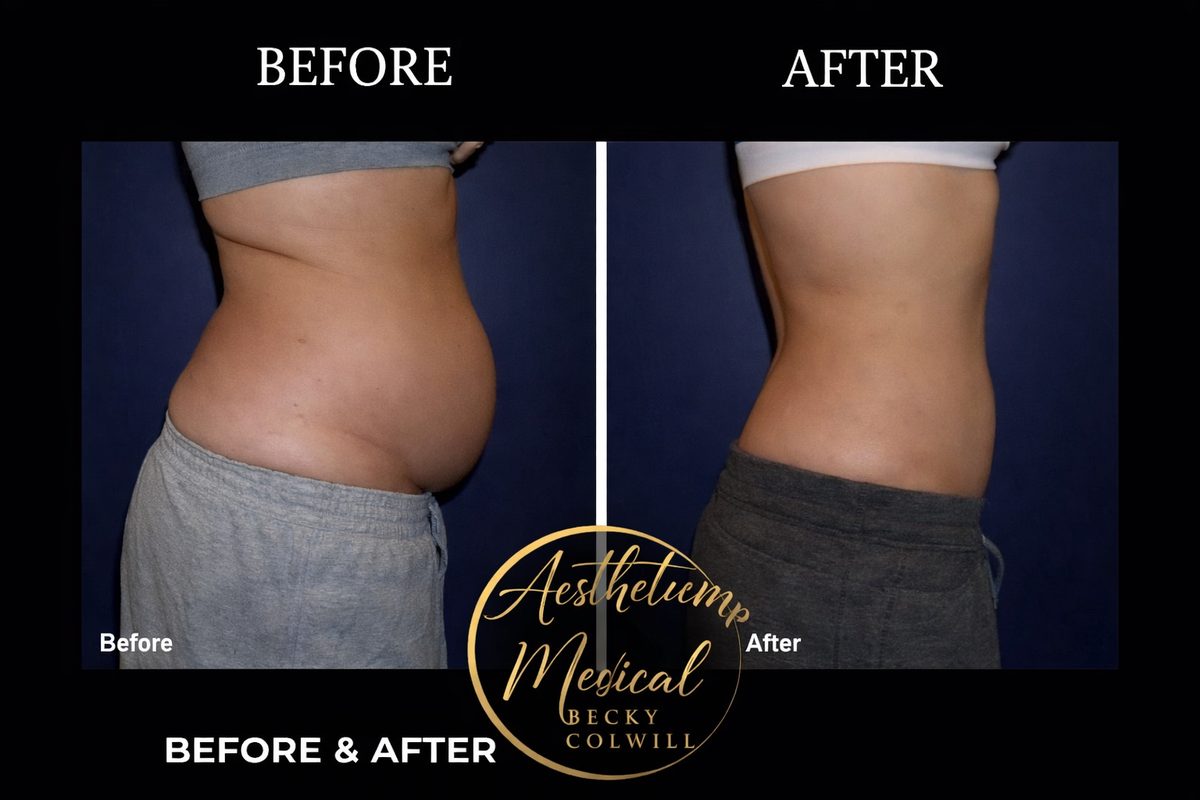 Endolift Body Sculpting results