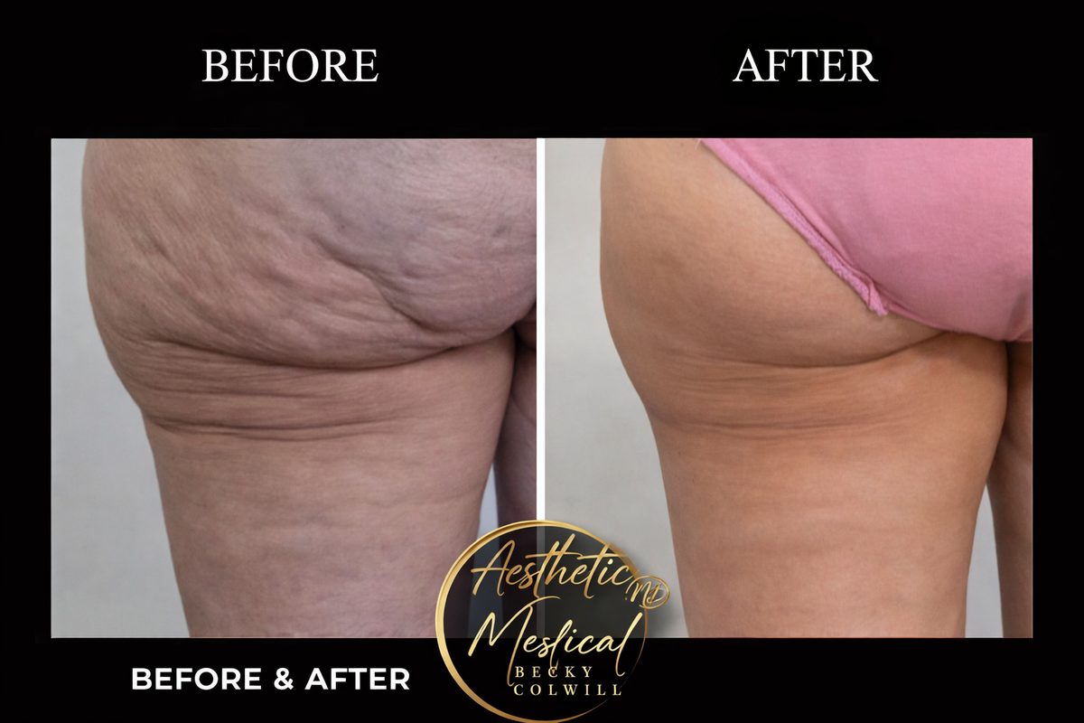 Endolift Body Sculpting results