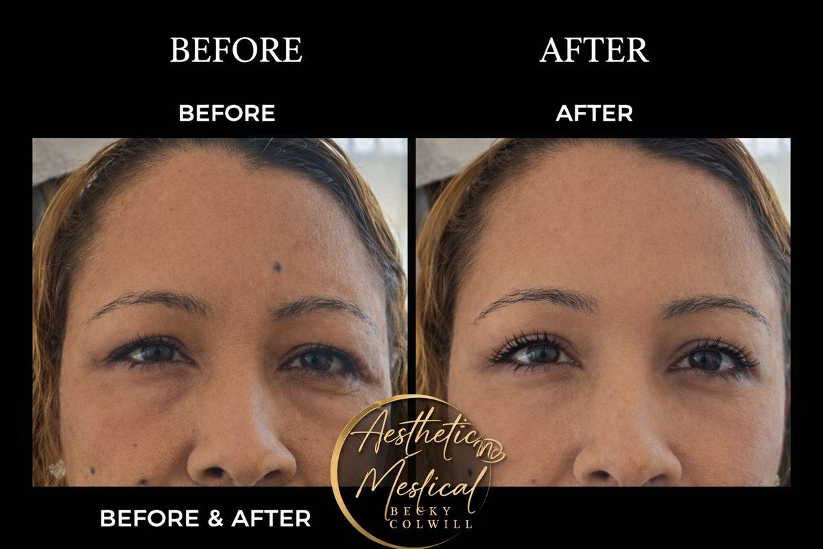 Endolift Eyes – Straight After results