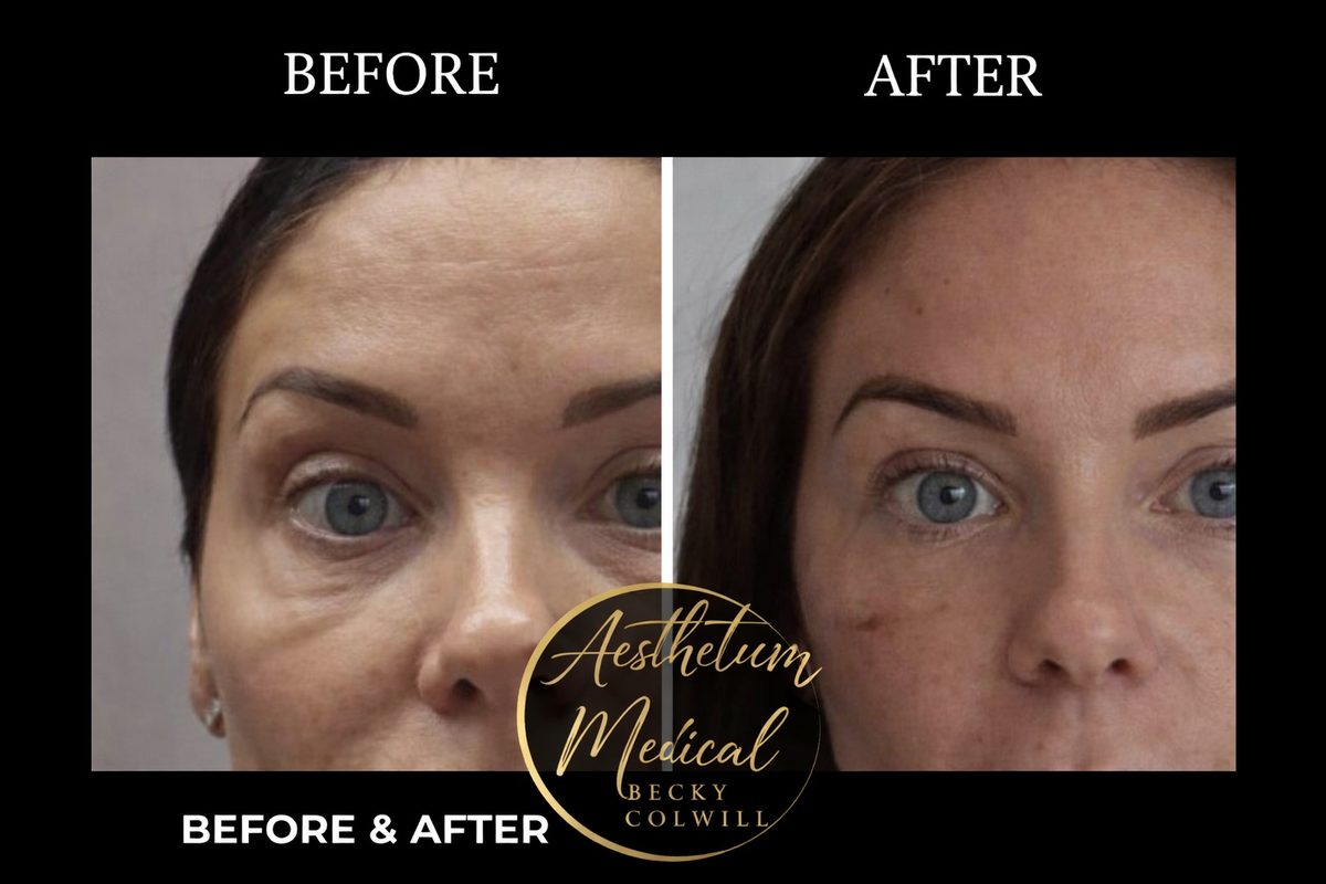 Endolift Eyes