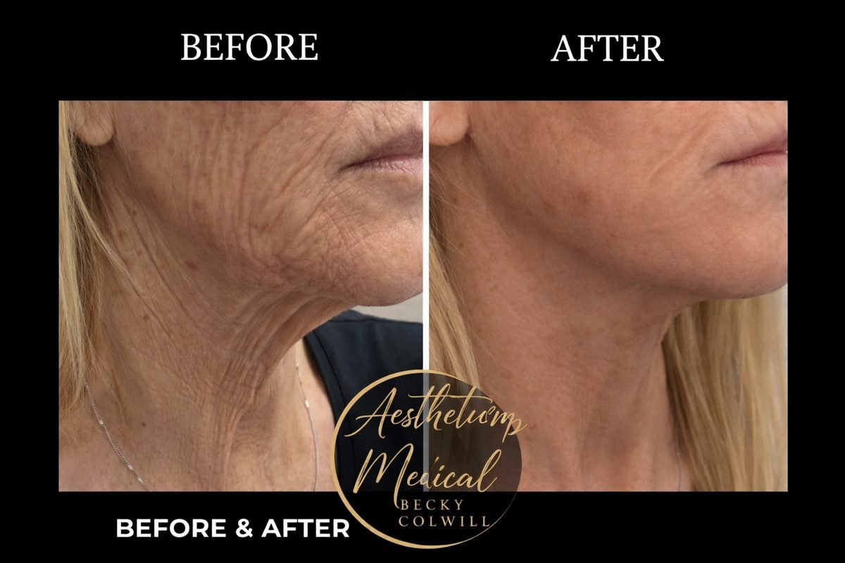 Endolift Face & Neck Lift results