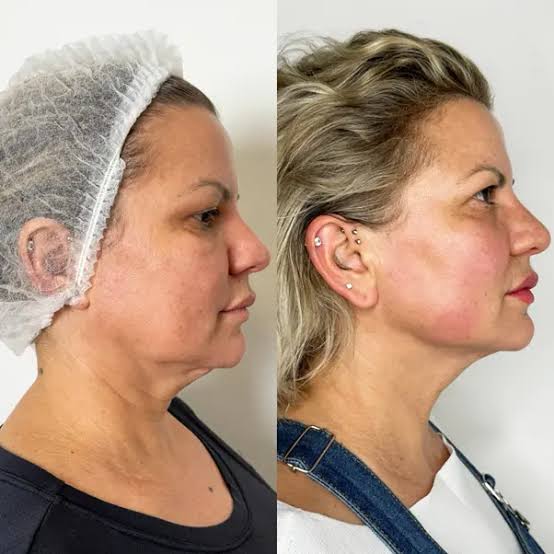 Endolift before and after - face and neck lift results
