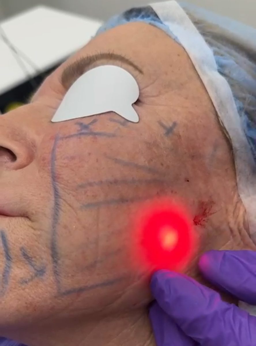 Endolift Full Face Lift results