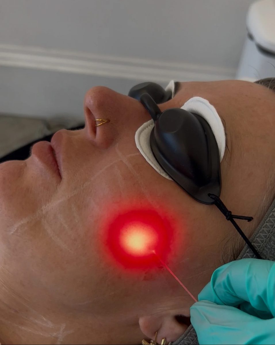Endolift Full Face