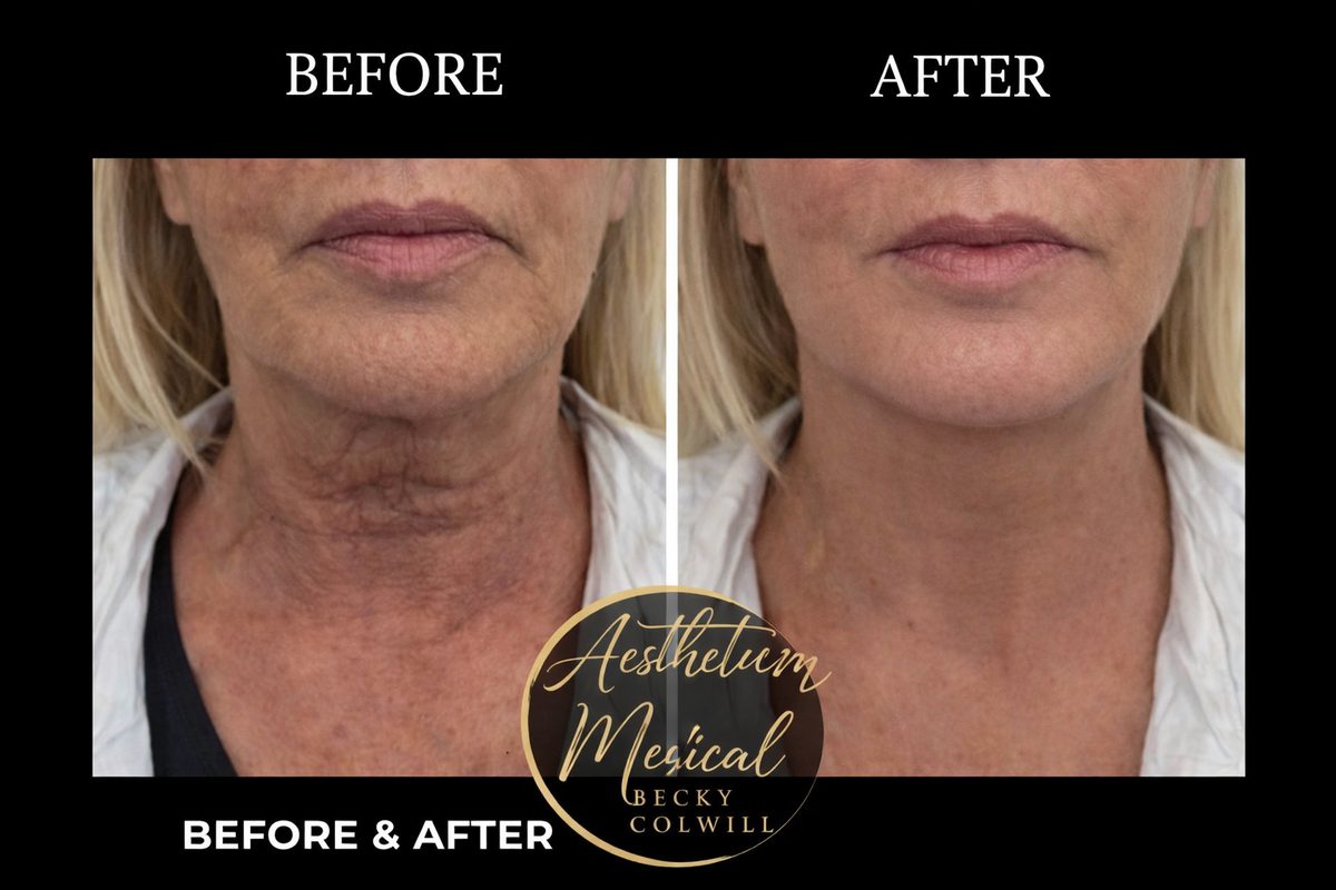 Endolift Jowls & Neck Lift results