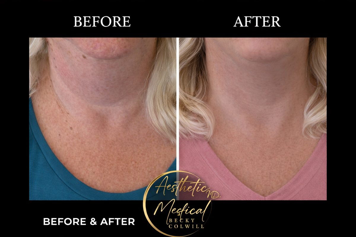 Endolift Neck Lift results