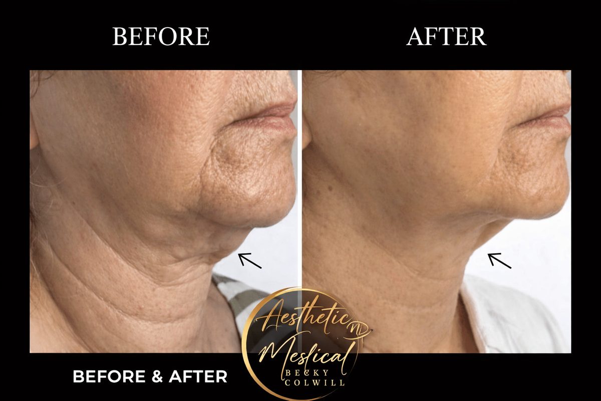 Endolift Neck Lift