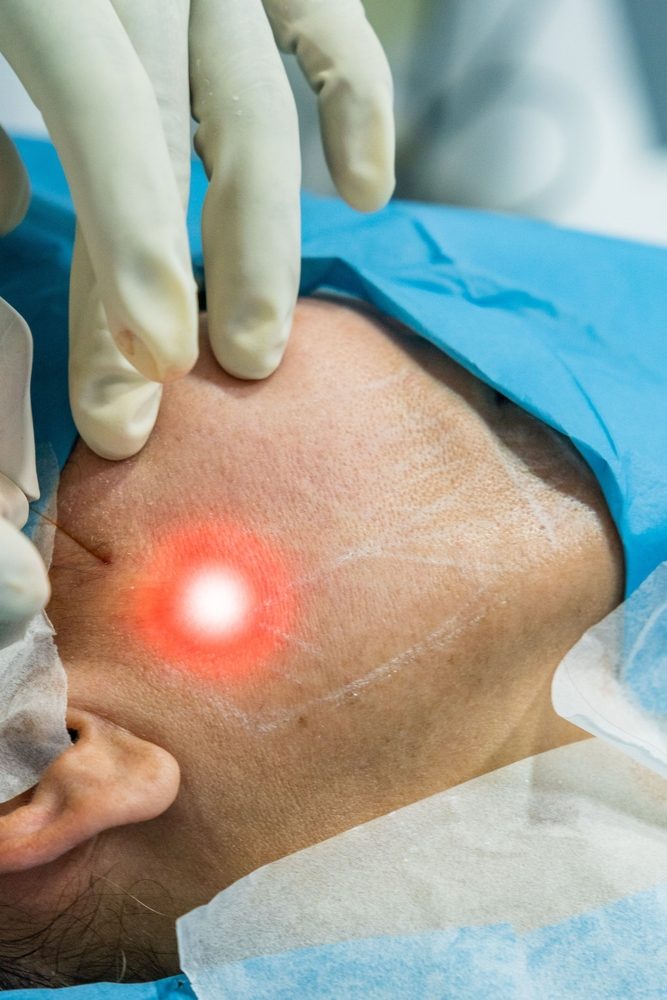 Endolift laser procedure being performed on jawline