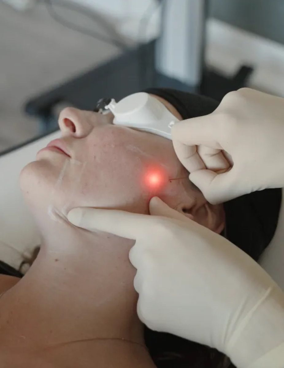 Endolift treatment on neck area with laser fibre